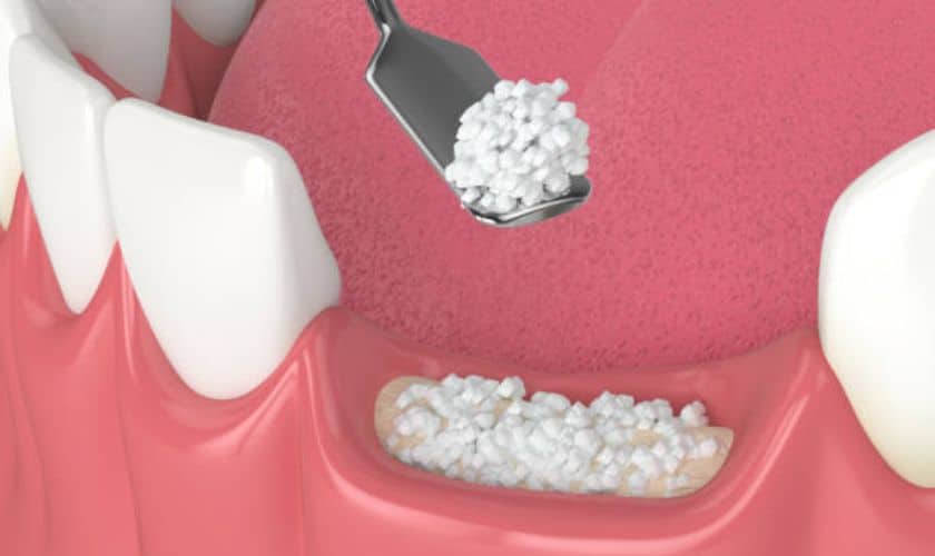Featured image for “When Do You Need a Dental Bone Graft?”