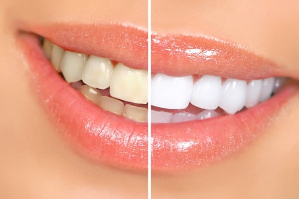 Featured image for “Is Teeth Whitening Right for Me?”
