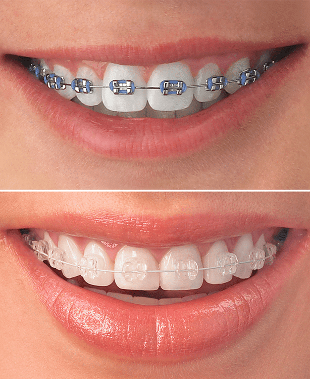 Clear Braces Rohnert Park, CA, Graton Dental Group, Nearly Invisible  Braces