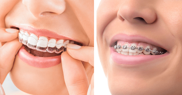Teen Invisalign and Braces - Before and After