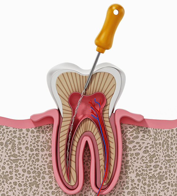 root canal infection
