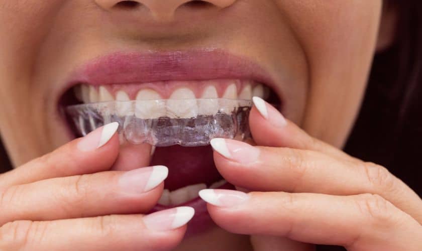 Featured image for “How Invisalign Can Improve Your Oral Health”