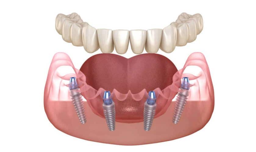Featured image for “All-on-4 Dental Implants: Exploring the Facts and Finding the Best Option”