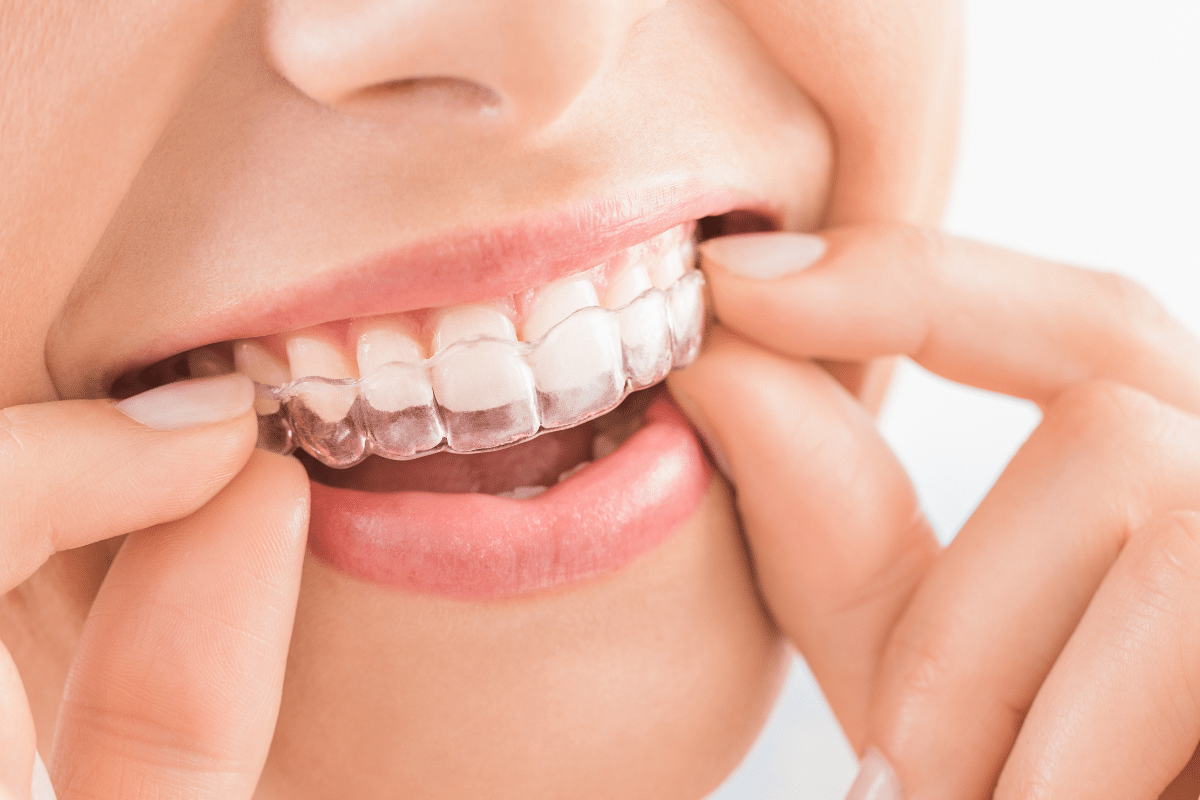 Featured image for “How Invisalign Helps Eliminate Gaps in Teeth”