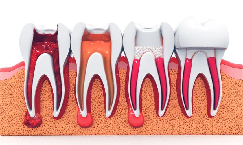 Featured image for “Demystifying Root Canal Treatment: Everything You Need to Know”