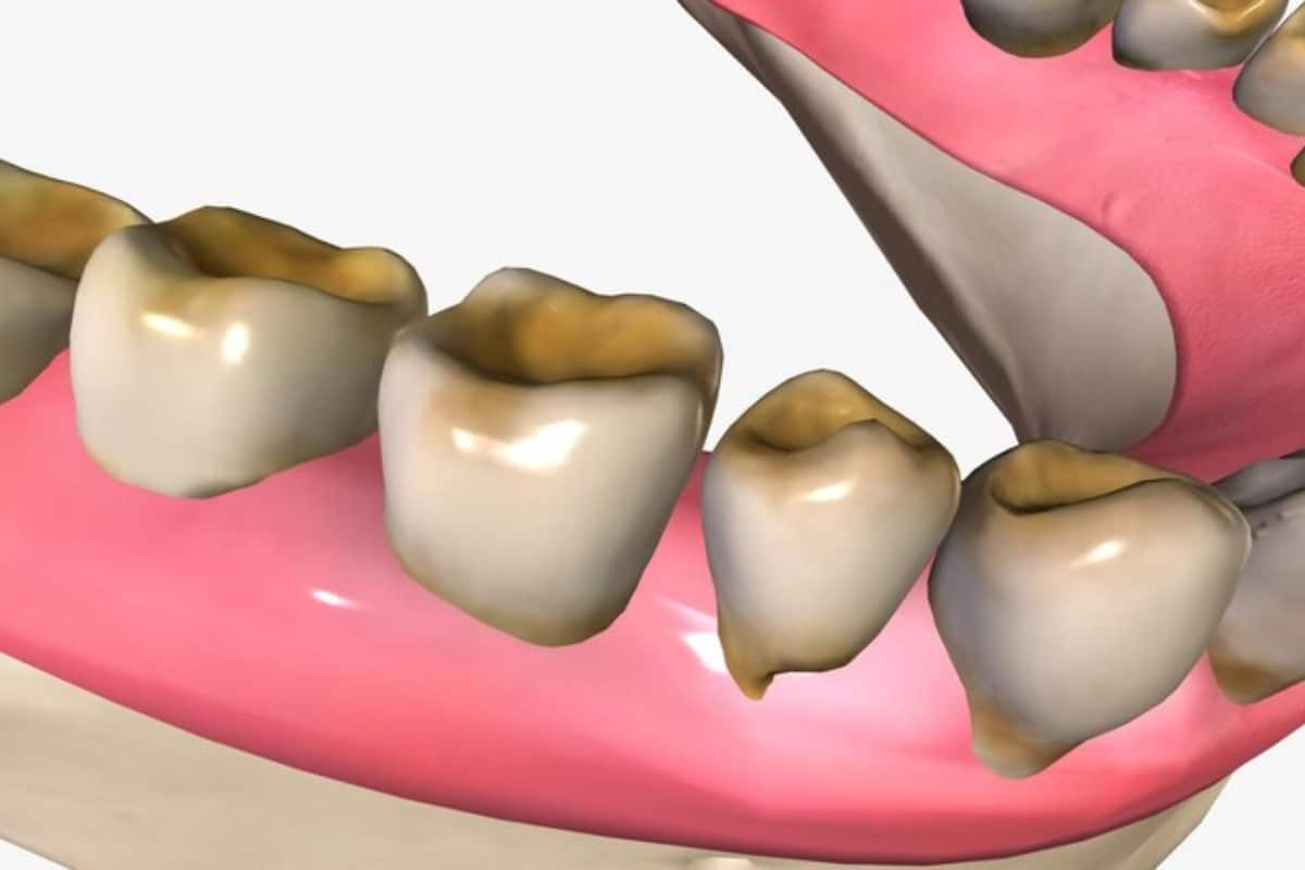Featured image for “Mastering Dental Plaque Removal Techniques”