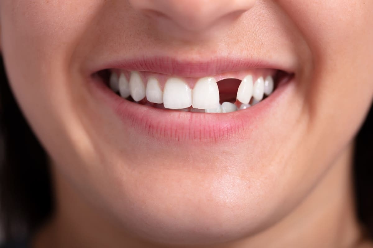 Featured image for “Uncovering the Impact of Failing or Missing Teeth on Your Well-being”