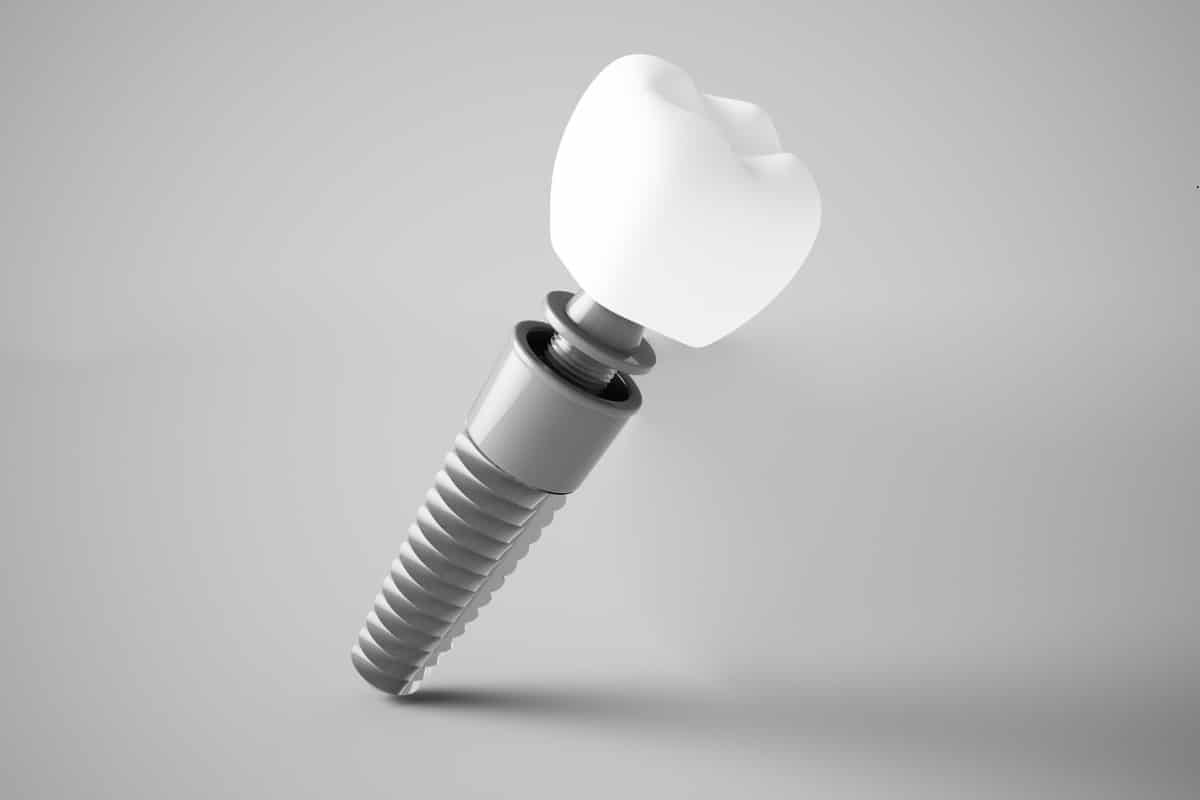 Featured image for “Discover the Long-Term Advantages of Dental Implants for Your Oral Health”