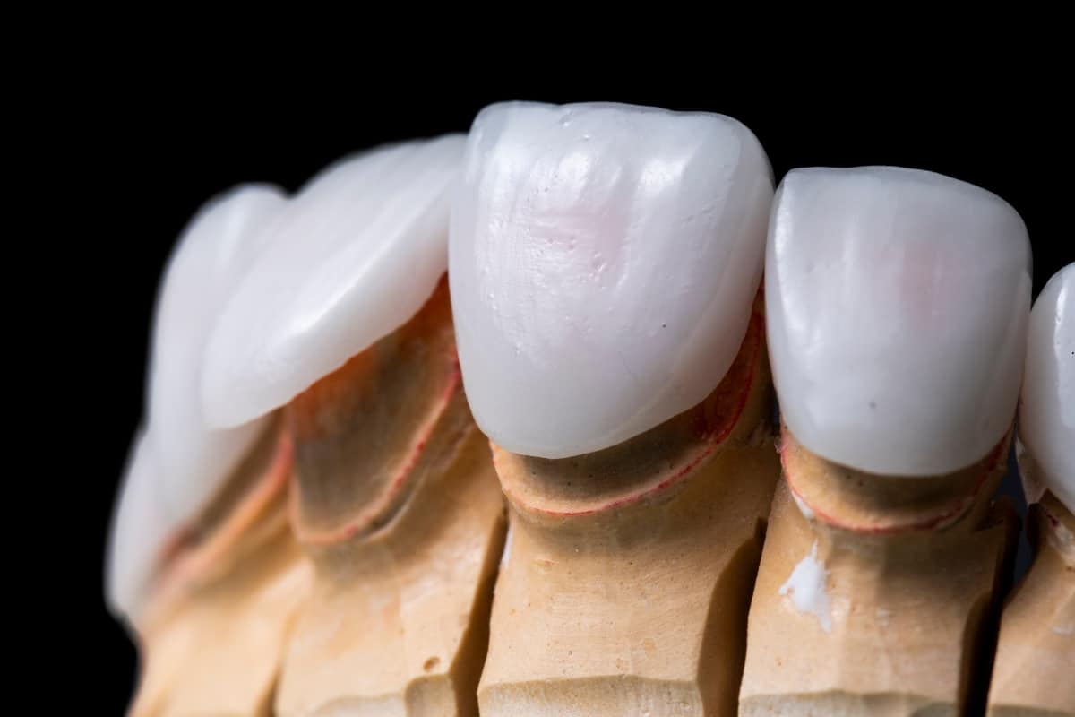 Featured image for “How to Choose the Best Veneer Teeth Covers for a Perfect Smile”