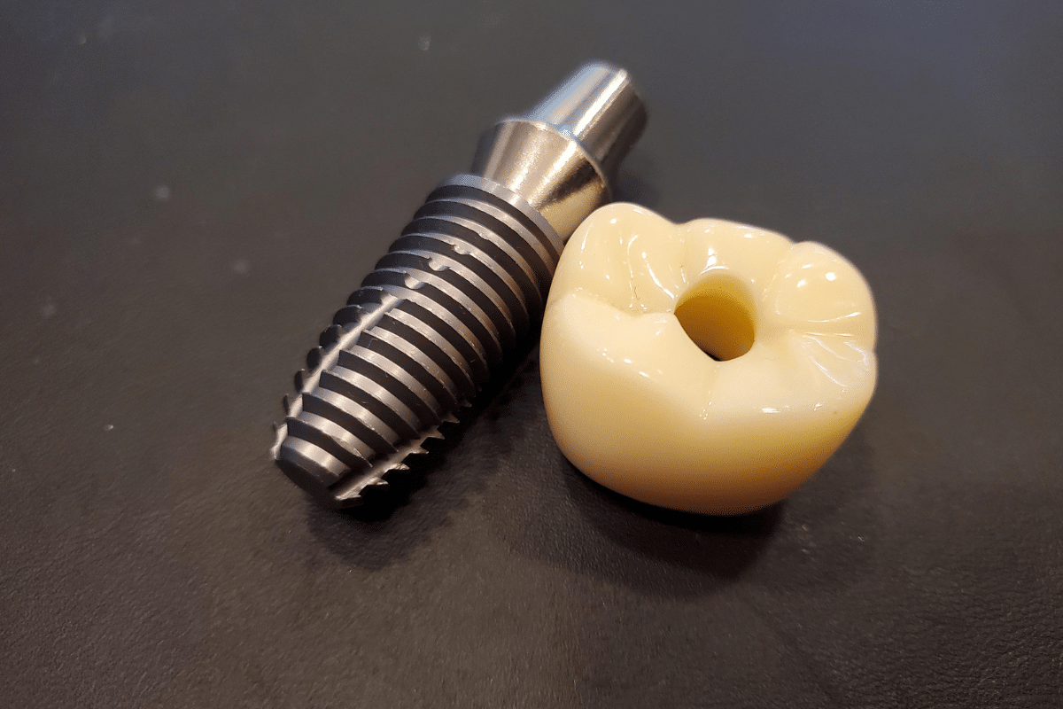 Featured image for “How Advanced Materials Are Improving Dental Implants”