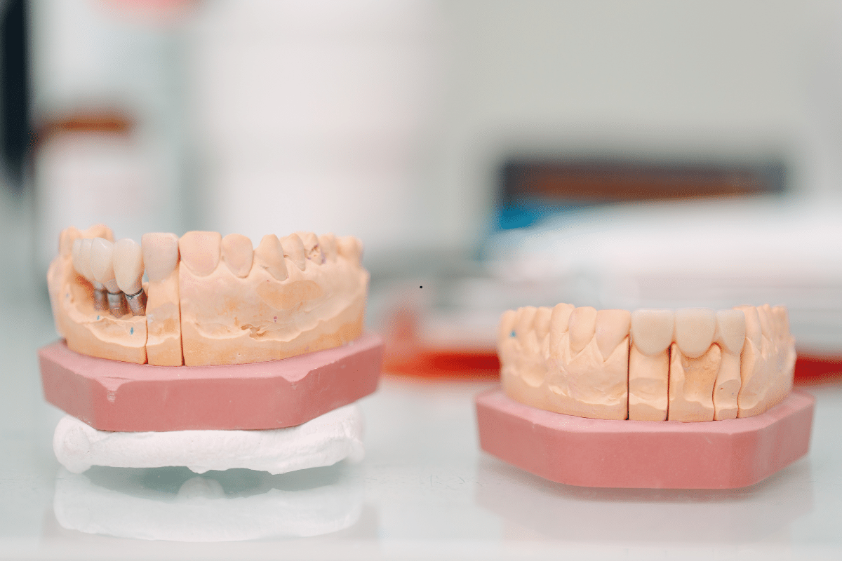 Featured image for “Mini vs. Traditional Implants: Choosing the Right Smile Solution”