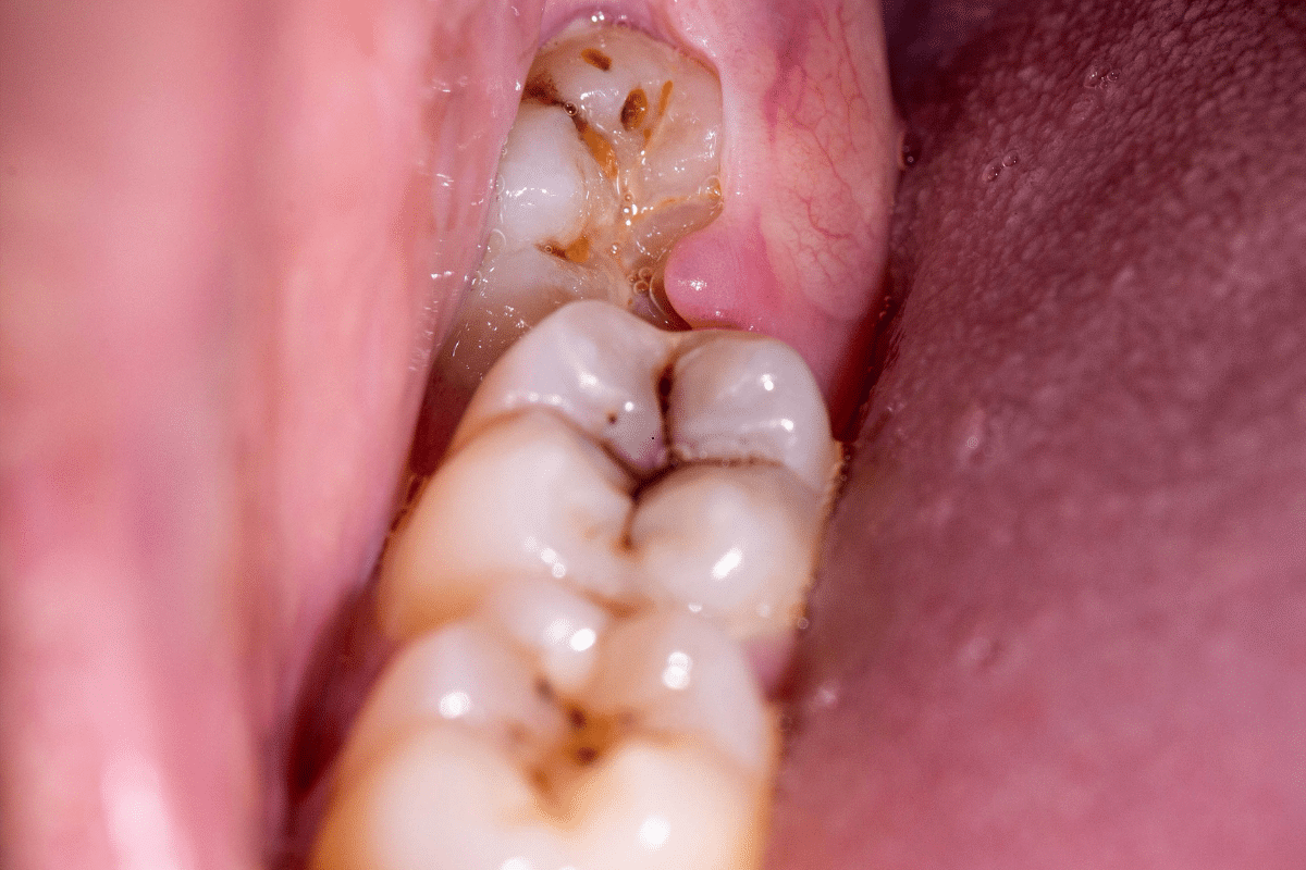 Featured image for “The Silent Threat in Your Jaw: How Cysts Can Cause Tooth Loss”