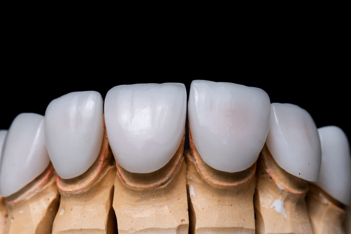 Featured image for “Veneer Regret: Why Some People Are Unhappy with Their Veneers and How to Avoid It”